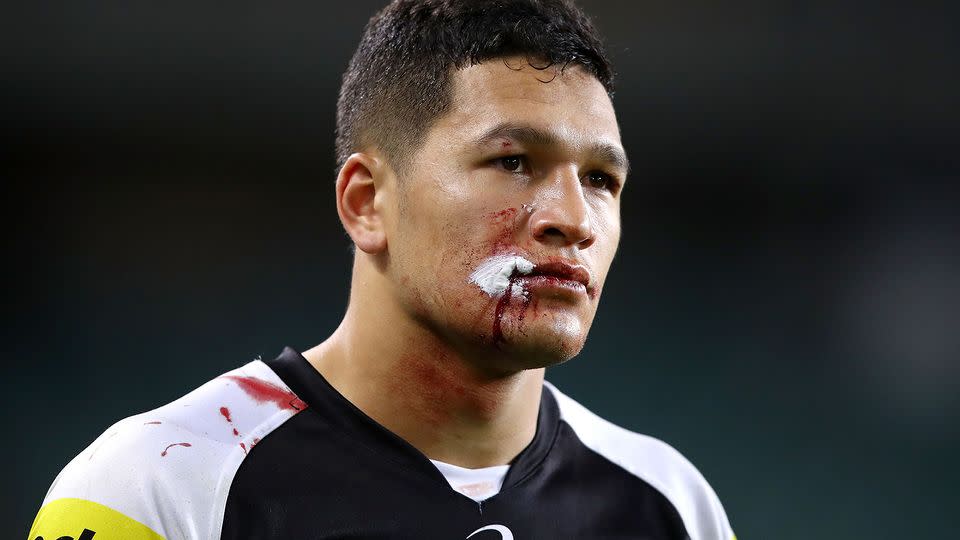 Watene-Zelezniak sports his battle wound. Pic: Getty