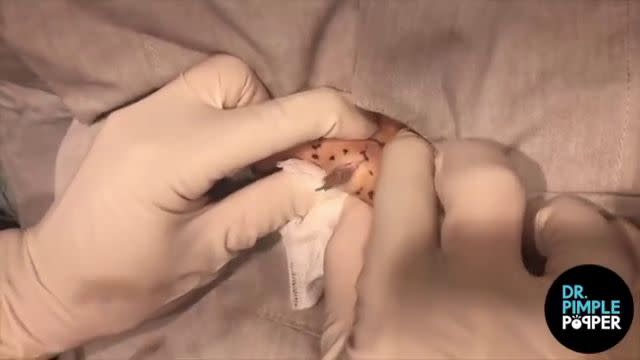 Dr. Pimple Popper -- Watch This Huge Boil Explode All Over The Doctor's  Shirt!