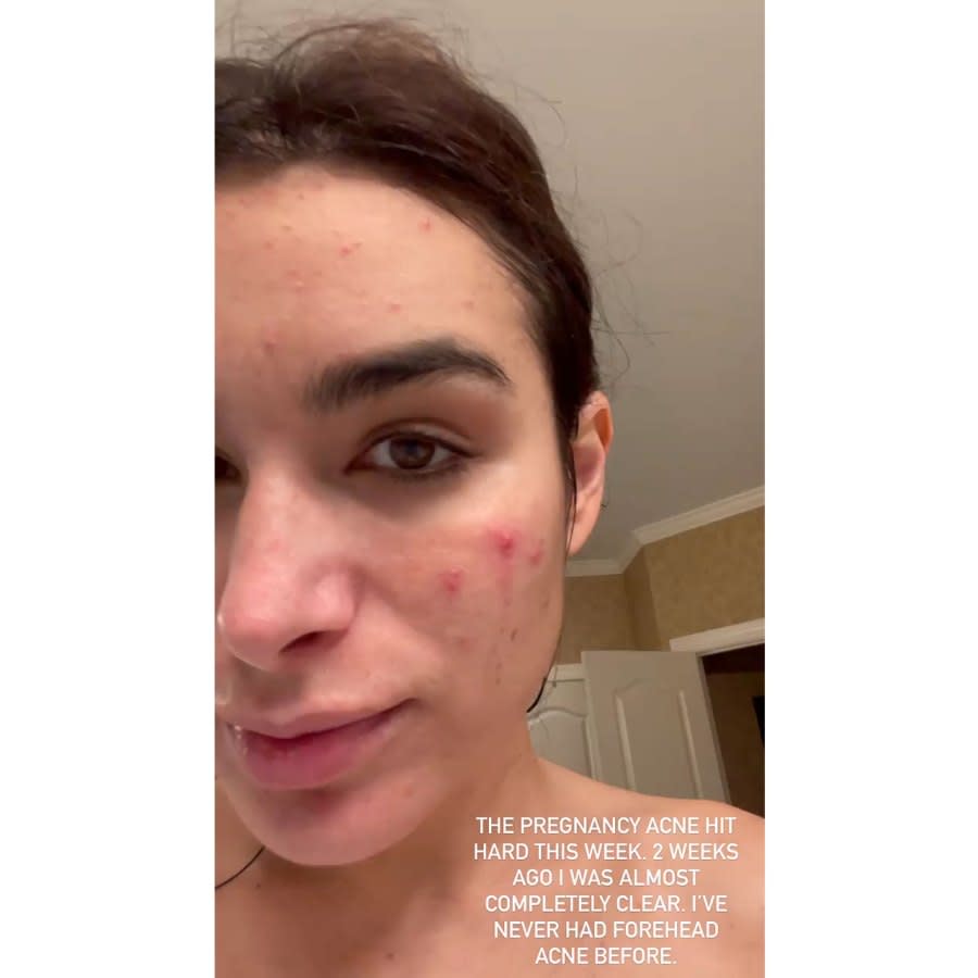 Bachelor Ashley Iaconetti Pregnancy Acne