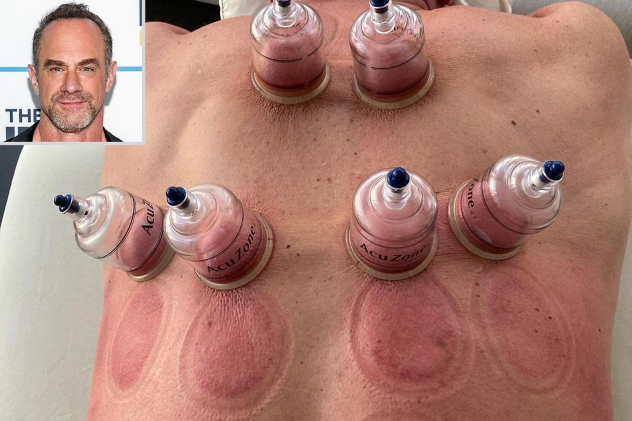 Chris Meloni Does Cupping Therapy