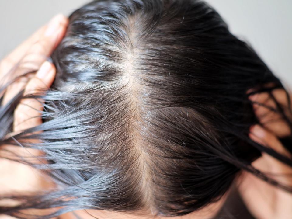 Top down view of a woman’s head with thinning hair along the part.