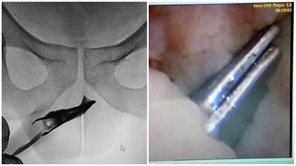 醫師檢查發現，男子的尿道內竟然塞進1根鑷子。(圖／翻攝自Science Direct)