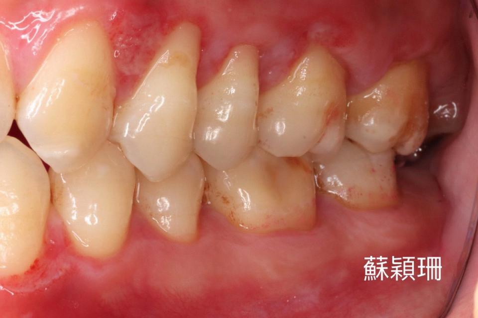 術前牙齦明顯外露。慈濟醫院提供