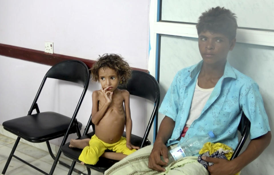 In this Aug. 25, 2018 image made from video, a severely malnourished girl waits for her turn to be treated at the Aslam Health Center in Hajjah, Yemen. Around 2.9 million women and children are acutely malnourished; another 400,000 children are fighting for their lives only a step away from starvation. Yemen’s civil war has wrecked the impoverished country’s already fragile ability to feed its population. (AP Photo/Hammadi Issa)