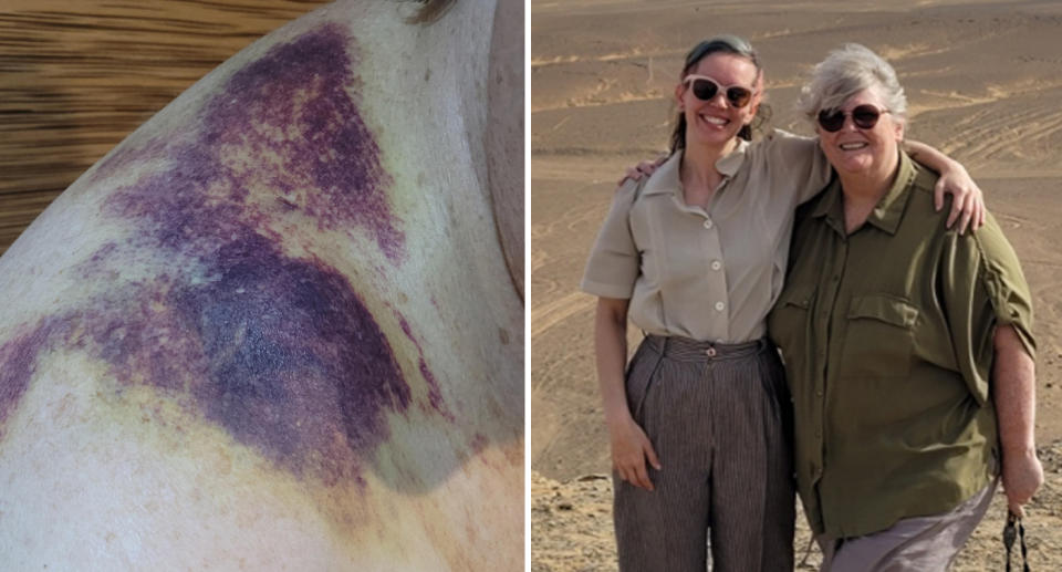 Left: Bruising caused by a broken collar bone. Right: Tourists Olivia and Carol posing in the Sahara Desert during their holiday