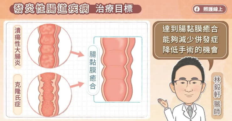 治療重點是腸道黏膜癒合