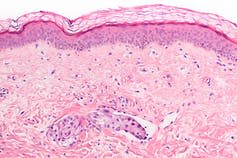<span class="caption">‘Inflammatory’ breast cancer, in which tumour cells spread through dermal lymphatic channels (vascular invasion) of the skin.</span> <span class="attribution"><a class="link " href="https://www.shutterstock.com/download/confirm/554909224?src=j42wLds0NclbTWp90FO9LQ-1-38&size=huge_jpg" rel="nofollow noopener" target="_blank" data-ylk="slk:Shutterstock;elm:context_link;itc:0;sec:content-canvas">Shutterstock</a></span>