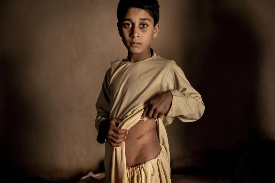 This image provided by World Press Photo is part of a series titled The Price of Peace in Afghanistan which won the World Press Photo Stories award by photographer Mads Nissen, Politiken / Panos Pictures, shows unable to afford food for the family, the parents of Khalil Ahmad, 15, decided to sell his kidney for US$3,500. The lack of jobs and the threat of starvation has led to a dramatic increase in the illegal organ trade. Herat, Afghanistan, Jan. 19, 2022. (Mads Nissen, Politiken/Panos Pictures/World Press Photo via AP)