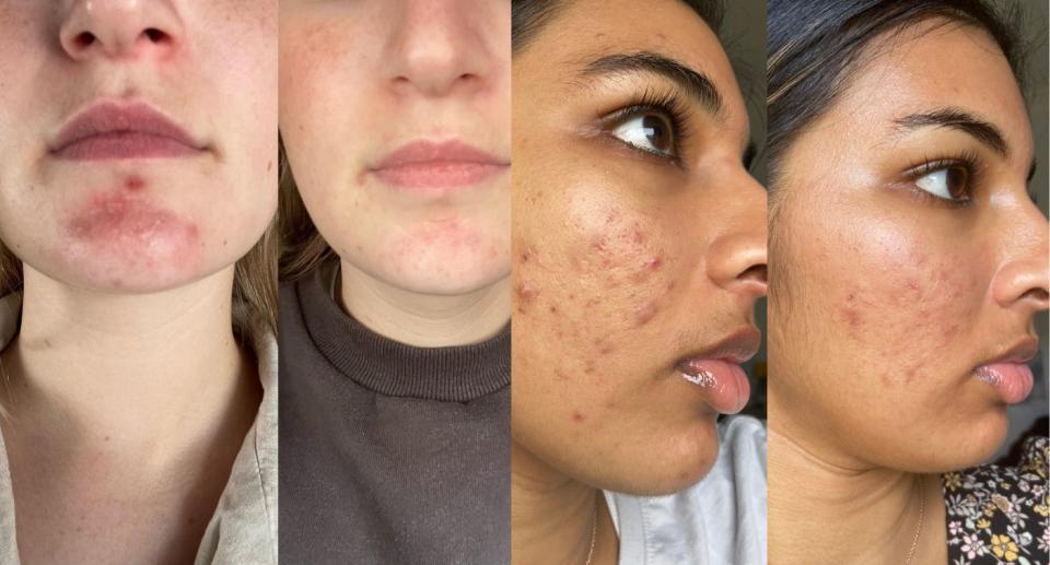 Before and after pictures of acne on chin and cheek.