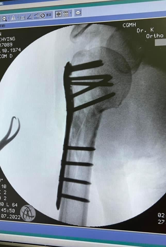 林志穎曾在社群網站上曬出右手臂的X光片。（圖／翻攝自微博）