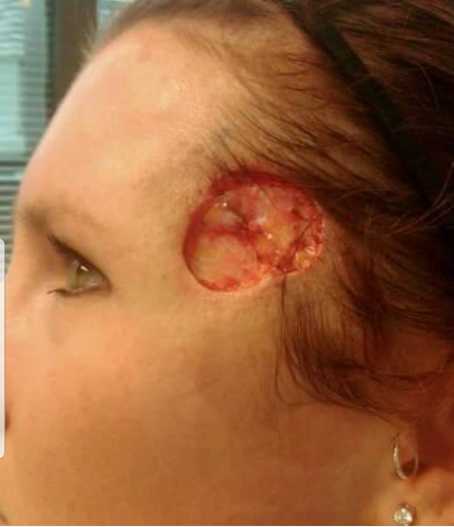 The devastating effect skin cancer had on Ms Doles. Source: MDRUM/ Australscope