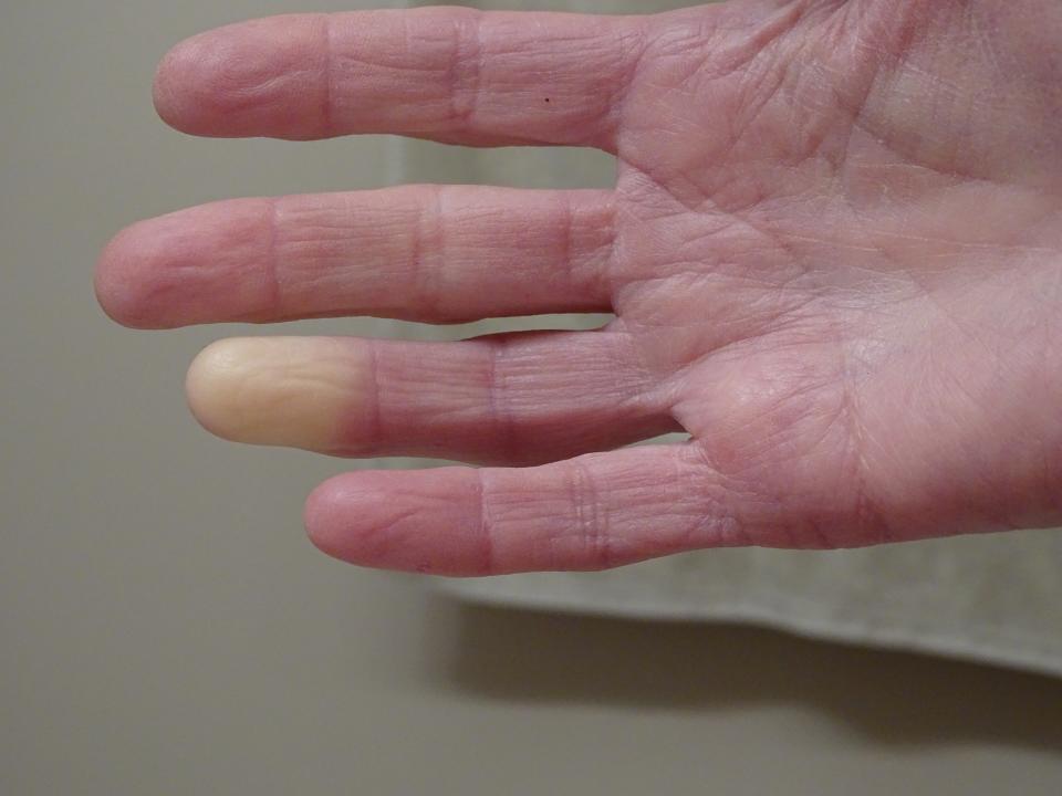 Suele haber cambios de coloración de las manos que, cuando se exponen al frío, se vuelven excesivamente pálidas y después violáceas, acompañándose a veces de dolor u hormigueo, síntomas que se conocen como '<a href="https://www.mayoclinic.org/es-es/diseases-conditions/raynauds-disease/symptoms-causes/syc-20363571" rel="nofollow noopener" target="_blank" data-ylk="slk:fenómeno de Raynaud;elm:context_link;itc:0;sec:content-canvas" class="link ">fenómeno de Raynaud</a>'. (Foto: Getty)