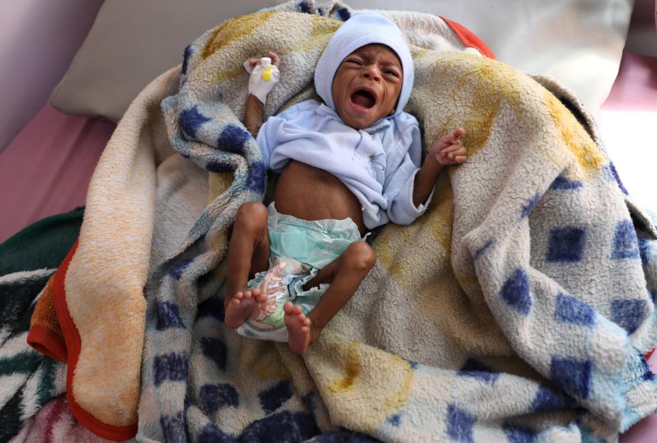 A malnourished child cries at the malnutrition treatment ward of al-Sabeen hospital in Sanaa, Yemen October 27, 2020. REUTERS/Khaled Abdullah (REUTERS)