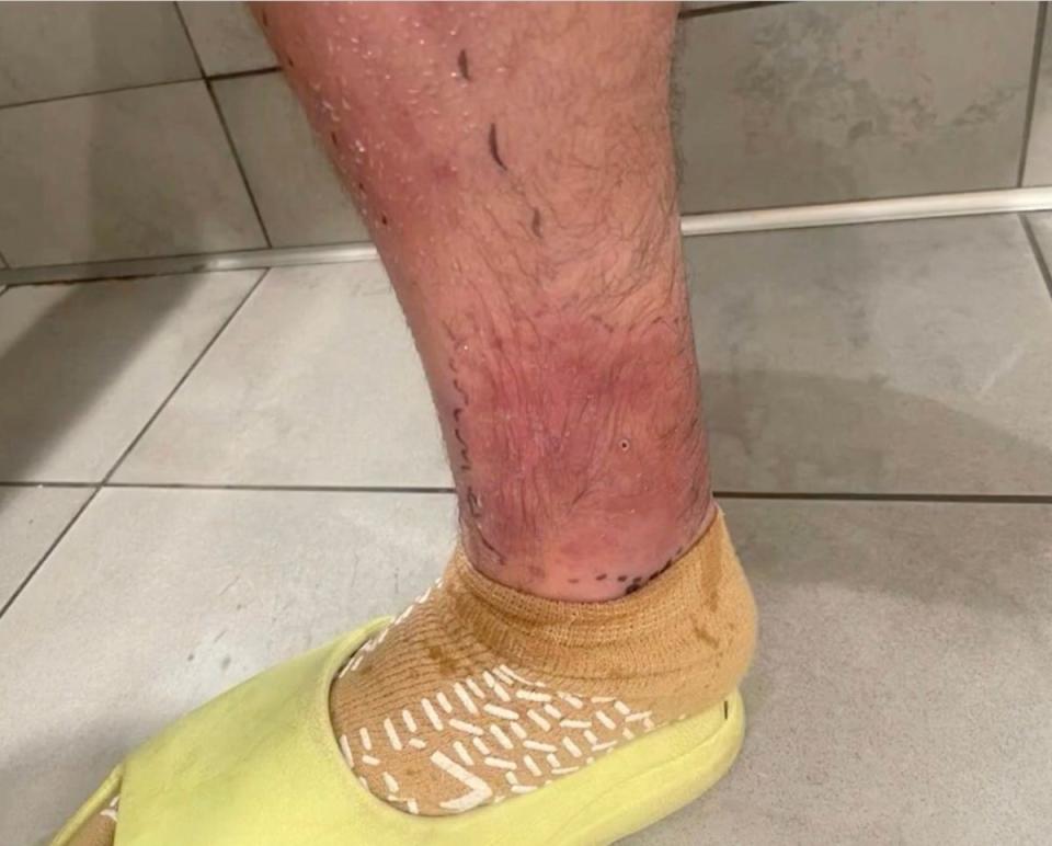 Lustman said he initially ignored the warning signs of his spider bite. (FOX5 Atlanta)