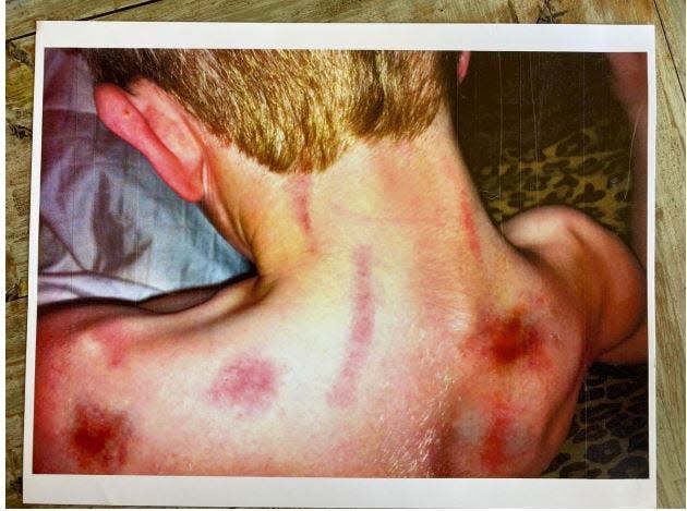 This photo from a federal lawsuit shows the injuries to Mason Mecklenburg, a former Kingfisher High School football player. The lawsuit alleges the wounds came from being flogged in the locker room with wet, knotted towels.