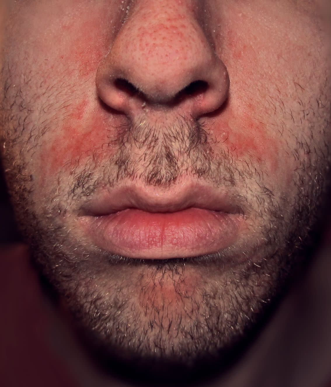 perioral dermatitis