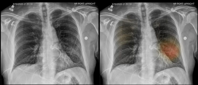 Two X-ray images show a patient's diseased lungs. Using an artificial intelligence program developed by Dr. Albert Hsiao and his colleagues at UC San Diego Health system, the image on the right has been dotted with spots of color indicating where there may be lung damage or other signs of pneumonia.