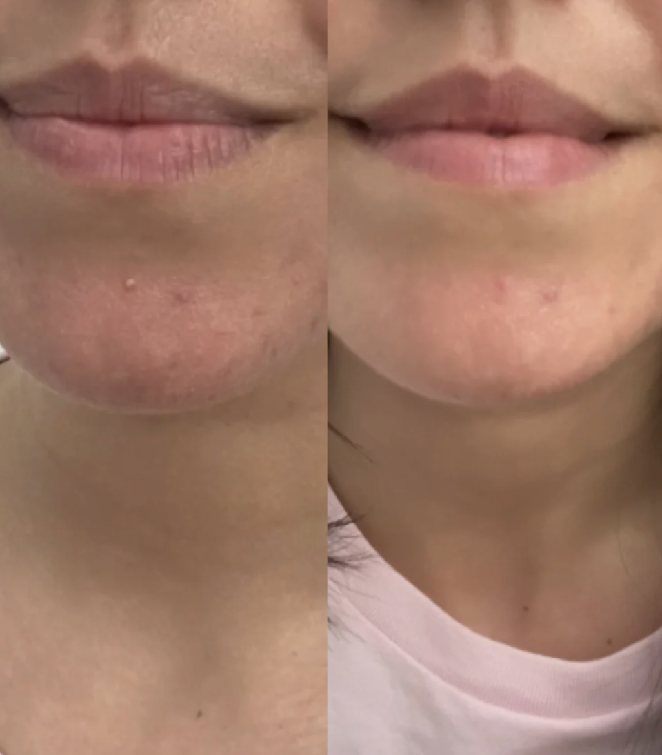 before and after shot of woman with pimples