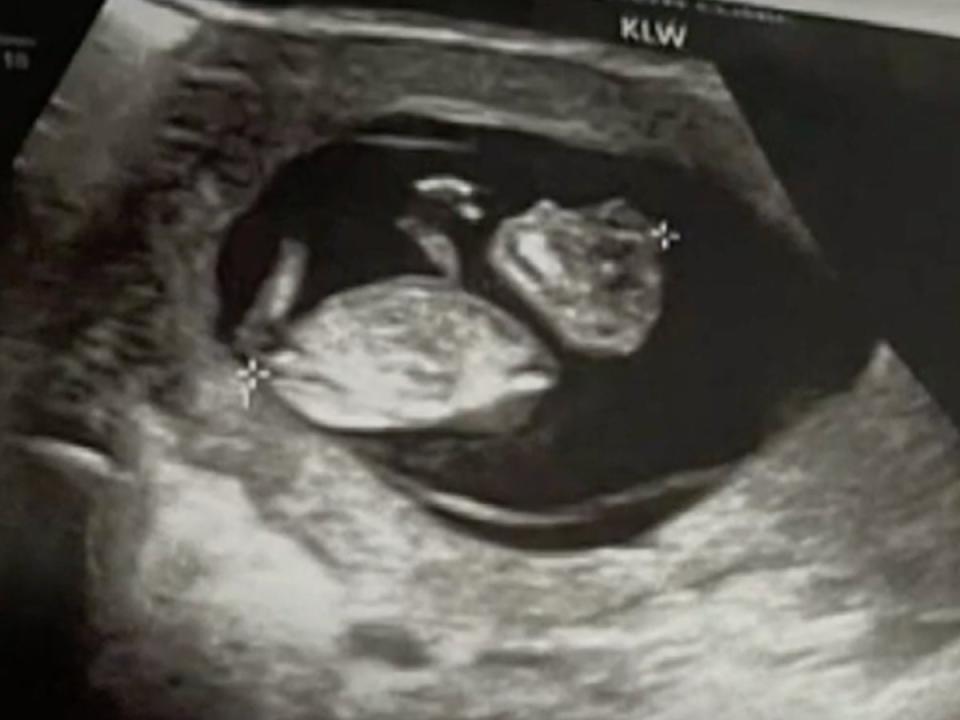 Nancy Davis’s child is seen on an ultrasound which shows its skull underdeveloped (Nancy Davis vis WAFB9)