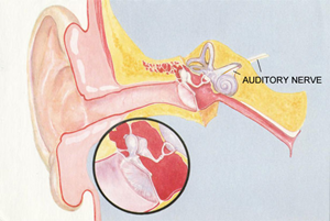 Sonus Complete is a supplement and might be a viable solution for tinnitus.