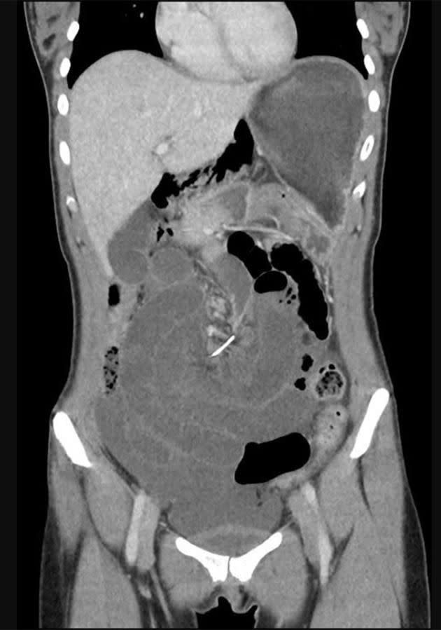 This is the wire lodged in the woman's stomach. Photo: BMJ