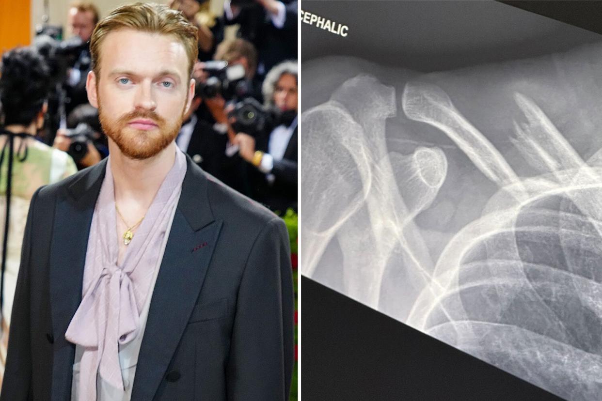Finneas Is Recovering After 'Demolishing My Collarbone' in Bike Accident