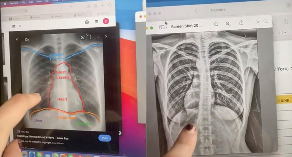 Screenshots from Claire Mack's TikTok videos showing the difference between where her organs sit and where they are in a normal person.