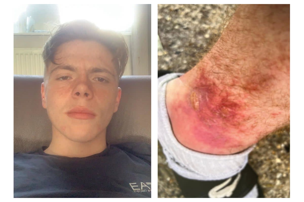 Daniel Logan was left with golf ball-sized blisters on his ankle after rushing against giant hogweed   (Pen News)