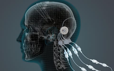 A port is placed into the patients head allowing infusions of growth factor to get to a specific area of the brain - Credit: MintMotion for Passionate Productions&nbsp;&nbsp;