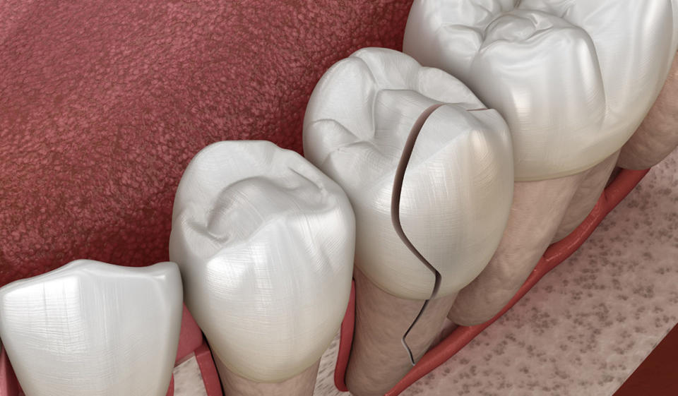 Cracked tooth - Dental emergencies