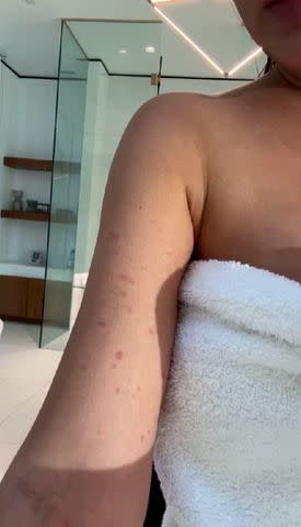 <p>Chrissy Teigen/Instagram</p> Chrissy Teigen shows off the burns on her upper arm in a video.