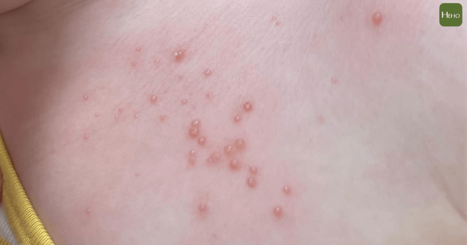 兒童皮膚出現珍珠串斑的丘疹，被診斷為傳染性軟疣病毒。兒童感染科醫師顏俊宇提供