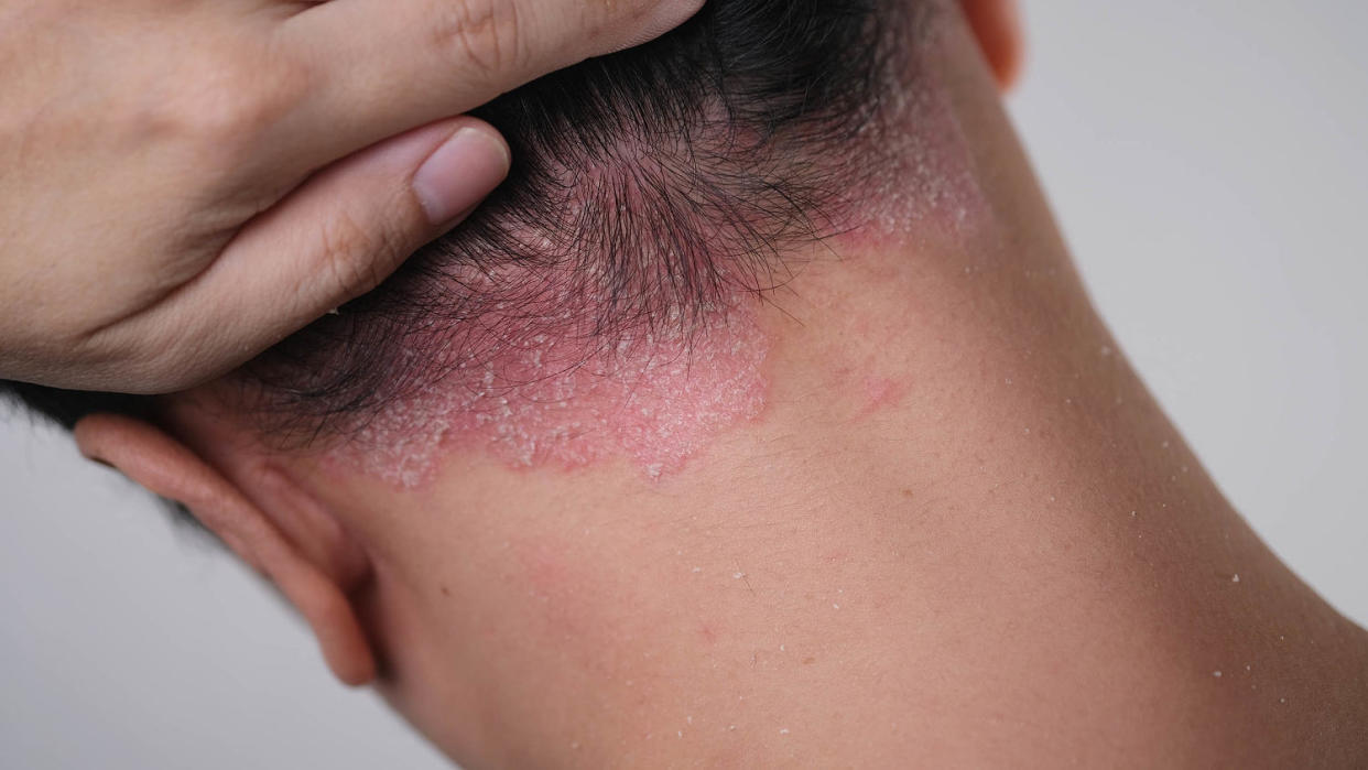 Psoriasis on the nape of a man. skin with psoriasis. (Getty Images)