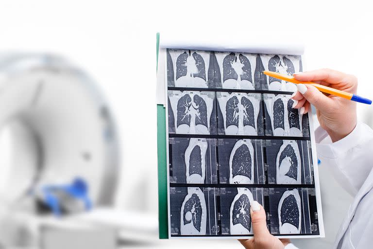 La detección temprana debe hacerse con una tomografía computada de baja dosis (TCBD) y en la población de entre 55 y 74 años de “alto riesgo”