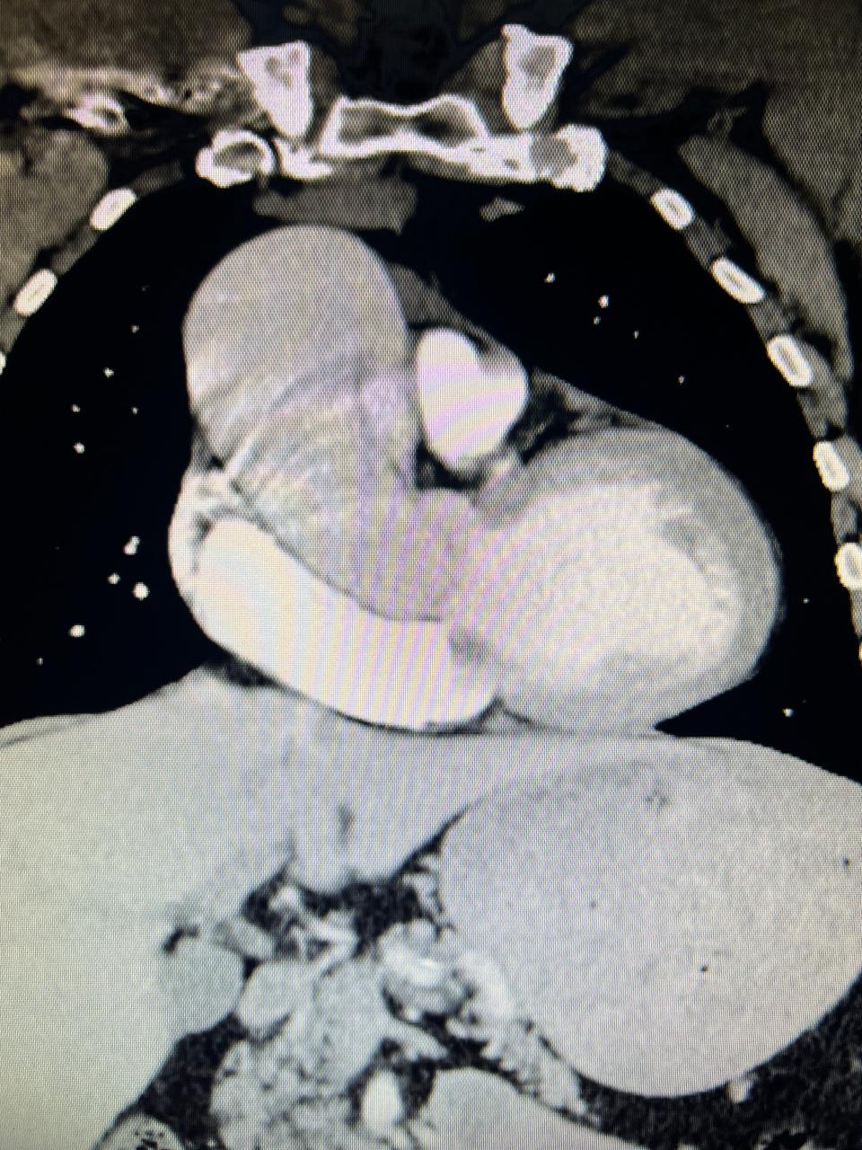 Steve Rosenberg's enlarged aorta is the large gray structure in the center. The heart's main pumping chamber, the left ventricle, is to the right. The right atrium is white. It collects unoxygenated blood and sends it to the right ventricle, not shown, which sends it to the lungs.