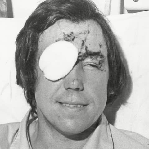 Gordon Banks after his car crash in 1972 - Credit: Jimmy James/REX