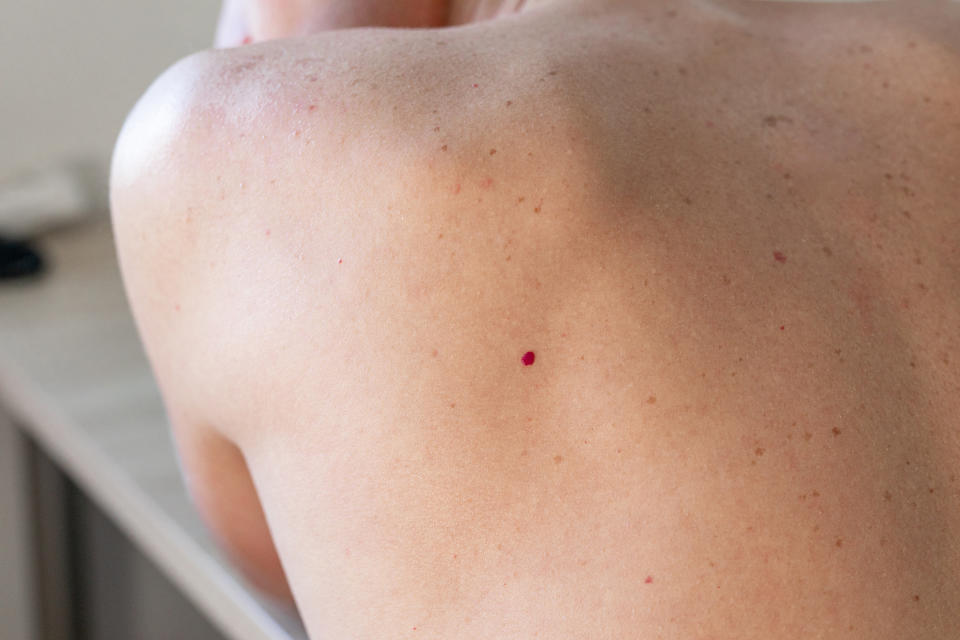 Los nevus rubí, puntos rubí o lunares de sangre, son pequeños puntos rojos que aparecen en la piel debido al envejecimiento. Aunque lo más habitual es que los puntos rubí aparezcan en adultos mayores de 40 años, es posible encontrarlos en jóvenes. (Foto: Getty)