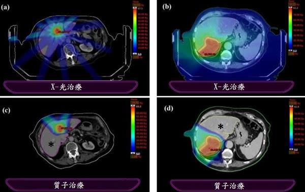 肝癌質子治療(下圖兩案例)能夠像深水炸彈將放射劑量集中在腫瘤，而不會像X光(上圖)穿透到許多正常組織。對肝硬化指數正常病患，只要有30%的正常肝臟(打星號處)沒有被照到，就可以安全的給予非常高劑量的消融性質子照射治療，並且具有最小的放射性肝傷害風險。（圖片提供／長庚醫院）