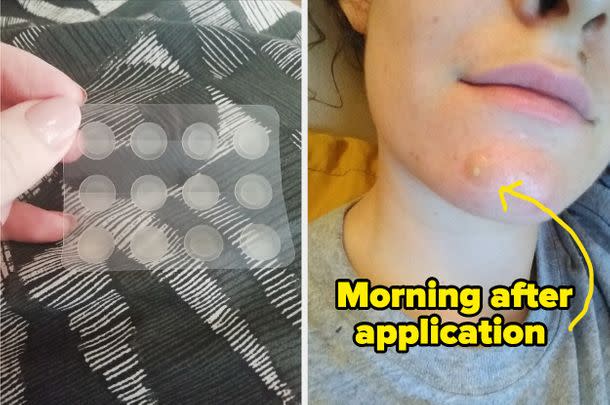 These viral TikTok blemish patches will cover AND heal your spots.