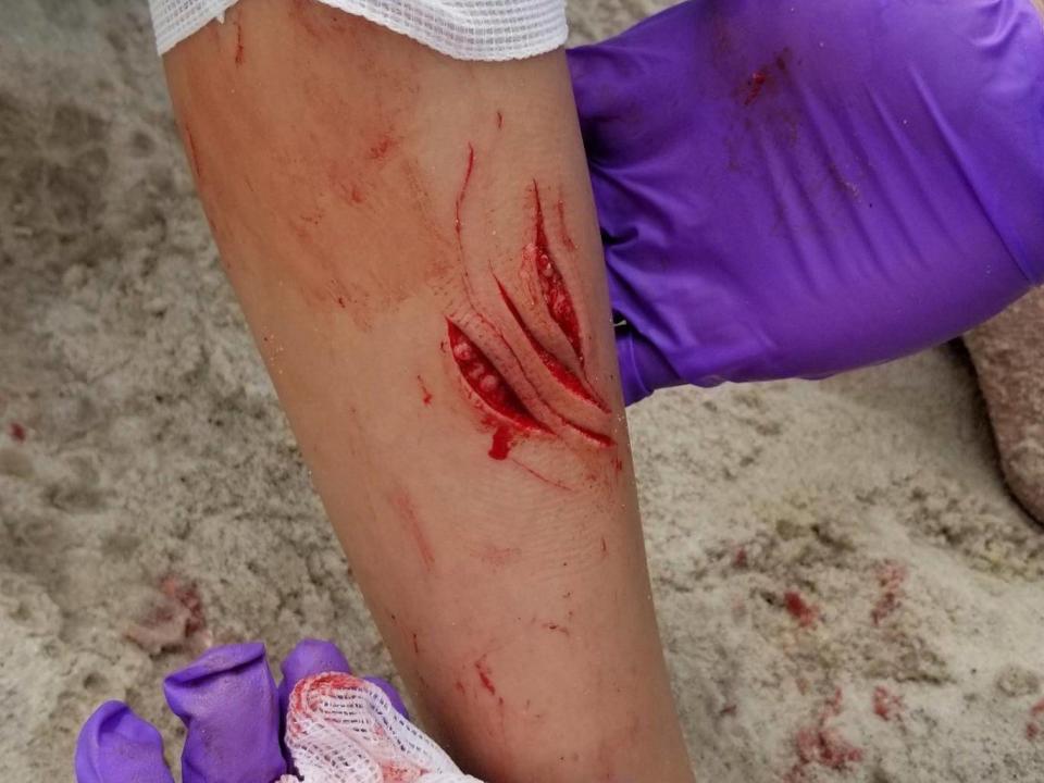 Lola Pollina, who suffered wounds on her right leg, was one of two children bitten in possible shark attacks off Fire Island beaches on Wednesday (AP)