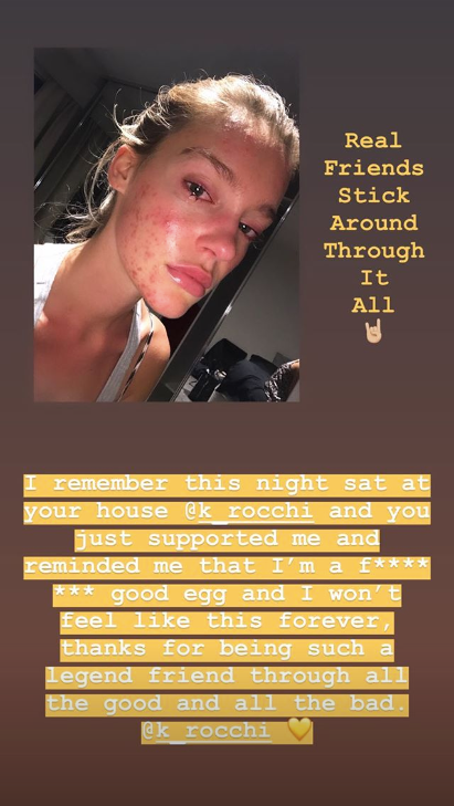 It has a been a long process but the model is finally in a better place when it comes to her health and her skin. Photo: Georgia Gibbs/Instagram/YouTube