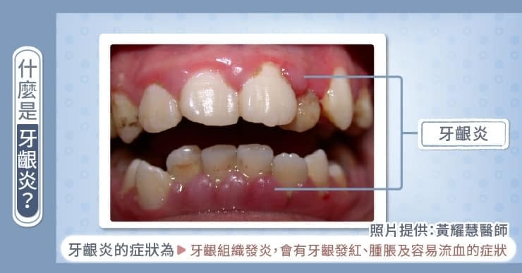 牙齦炎是什麼？