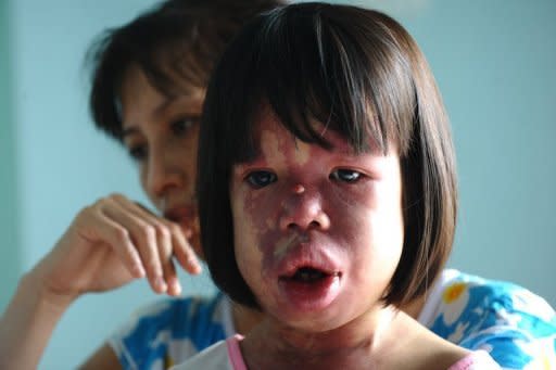 A suspected Agent Orange victim Nguyen Thi Hong Van and her mother Nguyen Thi Luu answer questions during an interview with AFP at their home near Vietnam's Danang Airbase