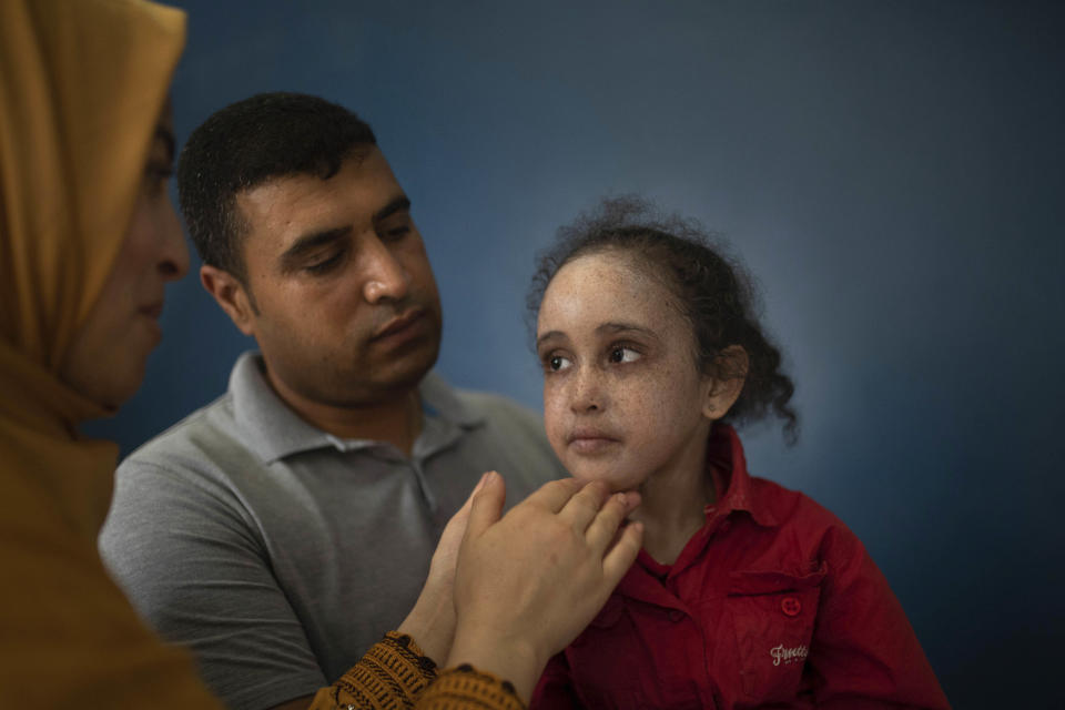 In this Wednesday, July 24, 2019 photo, Rabiaa Waraqa, left, and Salaheddine Elkalshi apply a cream to their 6 year-old daughter Yasmin, who is affected by a rare disorder called xeroderma pigmentosum, or XP, in Casablanca, Morocco. (AP Photo/Mosa'ab Elshamy)