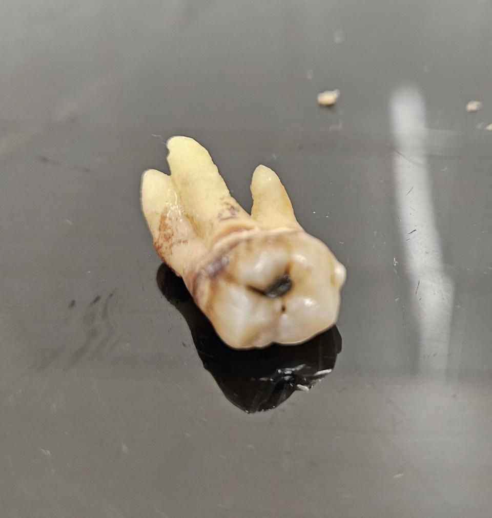 The extracted tooth. (Chris Langston / SWNS)