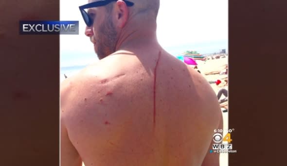 Shark attack saves man's life after cancer discovered 