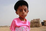 Yemeni boy fights malnutrition as hunger stalks nation's children