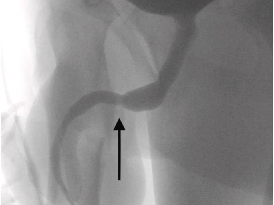 Surgeons successfully removed the USB cable. (Urology Case Reports)