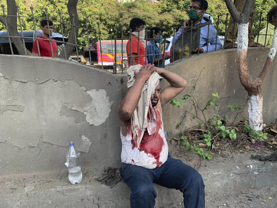 In this Wednesday, May 13, 2020, photo, a migrant holds a cloth to his head to stop the bleeding after a truck he was traveling in crashed in Thane, India. Tens of thousands of impoverished migrant workers are on the move across India, walking on highways and railway tracks or riding trucks, buses and crowded trains in blazing heat amid threat to their lives from the coronavirus pandemic. (AP Photo)