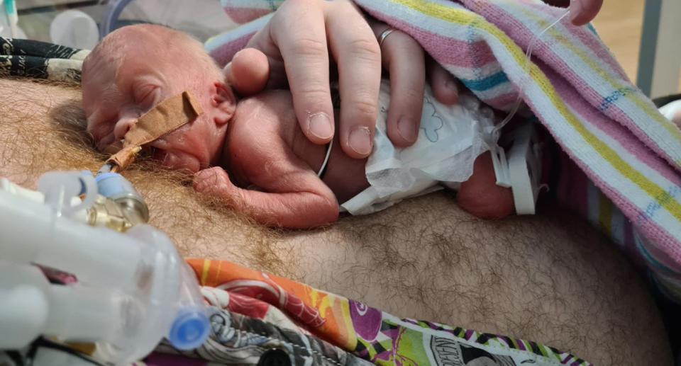 The premature baby lies against a chest wired up with tubes. 